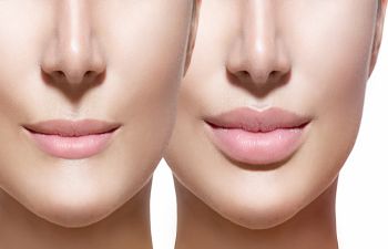 Lip Fillers New York NY