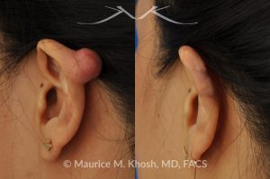Photo of a patient before and after a procedure. Keloid scar removal from the upper part of the ear (auricle)