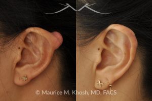 Photo of a patient before and after a procedure. Keloid scar removal from the upper part of the ear (auricle)