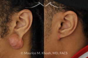 Photo of a patient before and after a procedure. Reconstruction of the ear after removing a large keloid from the earlobe