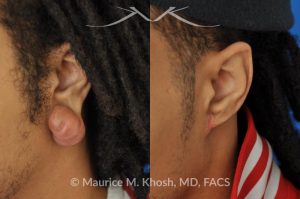 Photo of a patient before and after a procedure. Reconstruction of the ear after removing a large keloid from the earlobe