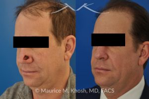 Photo of a patient before and after a procedure. Repair of Moh's defect of the lower nose with local skin flap