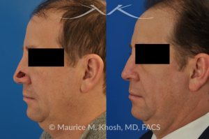 Photo of a patient before and after a procedure. Repair of Moh's defect of the lower nose with local skin flap - before and after photos.