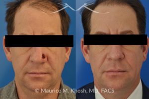 Photo of a patient before and after a procedure. Repair of Moh's defect of the lower nose with local skin flap