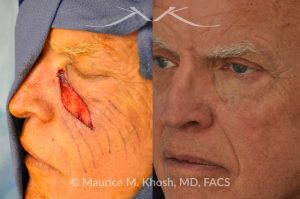 Photo of a patient before and after a procedure. Repair of melanoma excision defect in the cheek