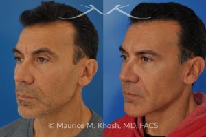 Photo of a patient before and after a procedure. Repair nasal valve obstruction revision rhinoplasty - This gentleman had previously undergone two rhinoplasty operations over 15 years ago. His nasal tip was pinched and obstructing his breathing, Cadaver rib cartilage was used to strengthen and support his external nasal valve. The nasal tip was slightly elevated.
