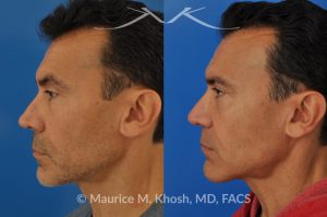 Photo of a patient before and after a procedure. Repair nasal valve obstruction revision rhinoplasty - This gentleman had previously undergone two rhinoplasty operations over 15 years ago. His nasal tip was pinched and obstructing his breathing, Cadaver rib cartilage was used to strengthen and support his external nasal valve. The nasal tip was slightly elevated.