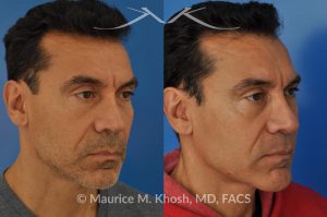 Photo of a patient before and after a procedure. Repair nasal valve obstruction revision rhinoplasty - This gentleman had previously undergone two rhinoplasty operations over 15 years ago. His nasal tip was pinched and obstructing his breathing, Cadaver rib cartilage was used to strengthen and support his external nasal valve. The nasal tip was slightly elevated.