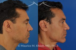 Photo of a patient before and after a procedure. Repair nasal valve obstruction revision rhinoplasty - This gentleman had previously undergone two rhinoplasty operations over 15 years ago. His nasal tip was pinched and obstructing his breathing, Cadaver rib cartilage was used to strengthen and support his external nasal valve. The nasal tip was slightly elevated.