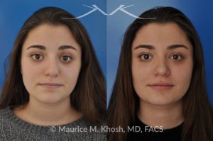 Photo of a patient before and after a procedure. Rhinoplasty (nose job) to straighten a crooked nose, lower nasal hump, and improve the nasal tip