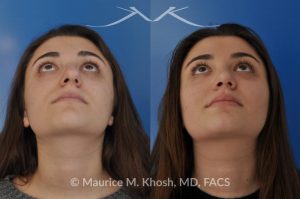 Photo of a patient before and after a procedure. Rhinoplasty (nose job) to straighten a crooked nose, lower nasal hump, and improve the nasal tip