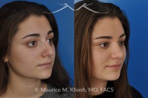 Photo of a patient before and after a procedure. Rhinoplasty (nose job) to straighten a crooked nose, lower nasal hump, and improve the nasal tip