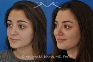 Photo of a patient before and after a procedure. Rhinoplasty (nose job) to straighten a crooked nose, lower nasal hump, and improve the nasal tip