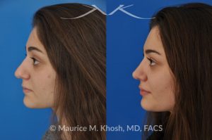 Photo of a patient before and after a procedure. Rhinoplasty (nose job) to straighten a crooked nose, lower nasal hump, and improve the nasal tip