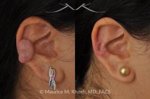 Photo of a patient before and after a procedure. Ear keloid  - scar removal the middle front part of the ear.