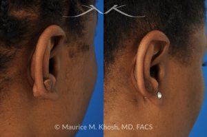 Photo of a patient before and after a procedure. Keloid - scar of the ear.