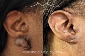 Photo of a patient before and after a procedure. Keloid - Keloid scar removal from the right earlobe.