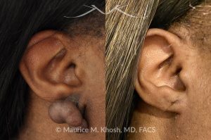 Photo of a patient before and after a procedure. Keloid - scar removal from the right earlobe.