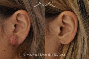 Photo of a patient before and after a procedure. Keloid - scar removed from the earlobe.