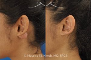 Photo of a patient before and after a procedure. Large keloid - scar removed from the back of the ear.