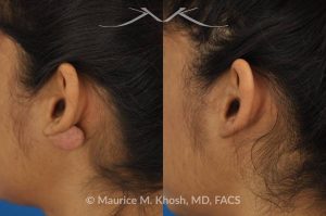 Photo of a patient before and after a procedure. Large keloid - scar removed from the back of the ear.