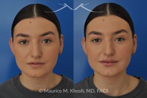Photo of a patient before and after a procedure. Lip Augmentation - This young lady was interested in enhancing the appearance of her lips. She was  noted to have small calibered and asymmetric upper lip. A hyaluronic acid filler (Volbella) was used to augment the upper and lower lips. Precise placement of the filler not only created fuller lips, it also allowed creation of symmetry in the upper lip.