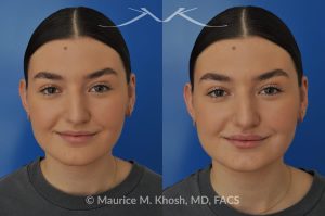Photo of a patient before and after a procedure. Lip Augmentation - This young lady was interested in enhancing the appearance of her lips. She was  noted to have small calibered and asymmetric upper lip. A hyaluronic acid filler (Volbella) was used to augment the upper and lower lips. Precise placement of the filler not only created fuller lips, it also allowed creation of symmetry in the upper lip.