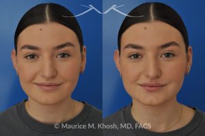 Photo of a patient before and after a procedure. Lip Augmentation - This young lady was interested in enhancing the appearance of her lips. She was  noted to have small calibered and asymmetric upper lip. A hyaluronic acid filler (Volbella) was used to augment the upper and lower lips. Precise placement of the filler not only created fuller lips, it also allowed creation of symmetry in the upper lip.