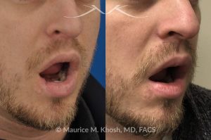 Photo of a patient before and after a procedure. Lip reconstruction - Lower lip reconstruction after dog bite.