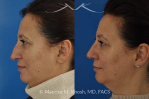 Photo of a patient before and after a procedure. Nose job - rhinoplasty to address droopy nasal tip and a large nasal hump.