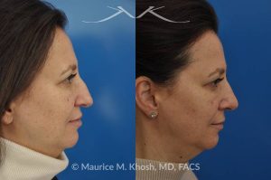 Photo of a patient before and after a procedure. Nose job - rhinoplasty to address droopy nasal tip and a large nasal hump.