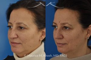 Photo of a patient before and after a procedure. Nose job - rhinoplasty to address droopy nasal tip and a large nasal hump.