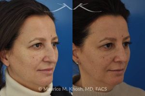 Photo of a patient before and after a procedure. Nose job - rhinoplasty to address droopy nasal tip and a large nasal hump.