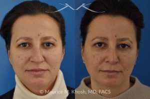 Photo of a patient before and after a procedure. Nose job - rhinoplasty to address droopy nasal tip and a large nasal hump.