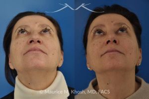 Photo of a patient before and after a procedure. Nose job - rhinoplasty to address droopy nasal tip and a large nasal hump.