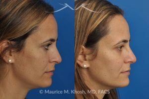 Photo of a patient before and after a procedure. Rhinoplasty - nose job to straigthen the bridge of the nose, elevate the depressed right side, and improve breathing.