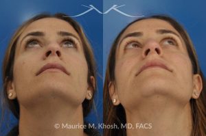 Photo of a patient before and after a procedure. Rhinoplasty - nose job to straigthen the bridge of the nose, elevate the depressed right side, and improve breathing.