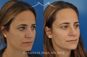 Photo of a patient before and after a procedure. Rhinoplasty - nose job to straigthen the bridge of the nose, elevate the depressed right side, and improve breathing.