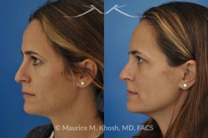 Photo of a patient before and after a procedure. Rhinoplasty - nose job to straigthen the bridge of the nose, elevate the depressed right side, and improve breathing.