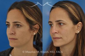 Photo of a patient before and after a procedure. Rhinoplasty - nose job to straigthen the bridge of the nose, elevate the depressed right side, and improve breathing.