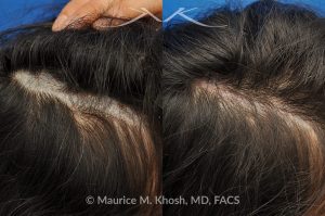 Photo of a patient before and after a procedure. Scalp scar revision - This 28 year-old lady had undergone scalp surgery which resulted in a wide and bald scar of the scalp which could not be fully camouflaged with her long hair. Scar revision of the scalp was performed inr Manhattan. The scar is more narrow and there is hair growth through the scar for further camouflage. 