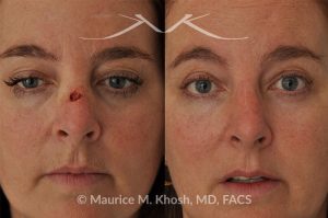 Photo of a patient before and after a procedure. Mohs Skin reconstruction - This 51 year old underwent Mohs excision of Basal Cell Cancer of the skin of the bridge of her nose. Skin flaps from the bridge of the nose were used to perform the mohs skin defect repair. The result of the cancer reconstruction is only a barely visible scar in the center of the nose.