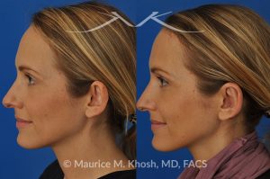 Photo of a patient before and after a procedure. Otoplasty  - This delightful 34 year old wanted to improve her protuberant ears. The left ear stuck out more than the right side. Otoplasty or ear pinning surgery was done in our office in Manhattan, under local anesthesia. Both ears were pushed back to a natural position. Symmetry between the position of two ears was achieved. 