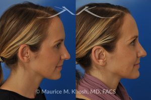 Photo of a patient before and after a procedure. Otoplasty  - This delightful 34 year old wanted to improve her protuberant ears. The left ear stuck out more than the right side. Otoplasty or ear pinning surgery was done in our office in Manhattan, under local anesthesia. Both ears were pushed back to a natural position. Symmetry between the position of two ears was achieved. 