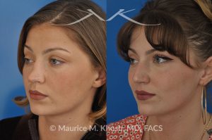 Photo of a patient before and after a procedure. saddle nose rhinoplasty - 27 year old with saddle nose collapse due to an autoimmune condition. She was bothered by the unnatural sag of the bridge of the nose, loss of nasal tip definition, and nasal obstruction. Her own rib cartilage was used during saddle nose rhinoplasty, to reconstruct the nose and restore breathing. The last two images show the computer simulation of surgical outcome (middle picture), as well as the final outcome (the picture on the right side). Patient is delighted with her results. 