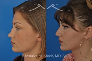 Photo of a patient before and after a procedure. Saddle nose rhinoplasty - 27 year old with saddle nose collapse due to an autoimmune condition. She was bothered by the unnatural sag of the bridge of the nose, loss of nasal tip definition, and nasal obstruction. Her own rib cartilage was used during saddle nose rhinoplasty, to reconstruct the nose and restore breathing. The last two images show the computer simulation of surgical outcome (middle picture), as well as the final outcome (the picture on the right side). Patient is delighted with her results. 