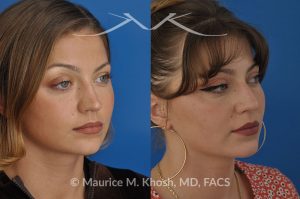 Photo of a patient before and after a procedure. saddle nose rhinoplasty - 27 year old with saddle nose collapse due to an autoimmune condition. She was bothered by the unnatural sag of the bridge of the nose, loss of nasal tip definition, and nasal obstruction. Her own rib cartilage was used during saddle nose rhinoplasty, to reconstruct the nose and restore breathing. The last two images show the computer simulation of surgical outcome (middle picture), as well as the final outcome (the picture on the right side). Patient is delighted with her results. 