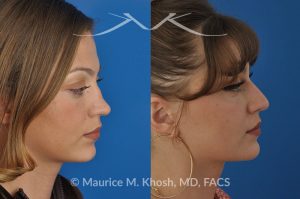 Photo of a patient before and after a procedure. saddle nose rhinoplasty - 27 year old with saddle nose collapse due to an autoimmune condition. She was bothered by the unnatural sag of the bridge of the nose, loss of nasal tip definition, and nasal obstruction. Her own rib cartilage was used during saddle nose rhinoplasty, to reconstruct the nose and restore breathing. The last two images show the computer simulation of surgical outcome (middle picture), as well as the final outcome (the picture on the right side). Patient is delighted with her results. 