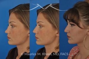 Photo of a patient before and after a procedure. saddle nose rhinoplasty - 27 year old with saddle nose collapse due to an autoimmune condition. She was bothered by the unnatural sag of the bridge of the nose, loss of nasal tip definition, and nasal obstruction. Her own rib cartilage was used during saddle nose rhinoplasty, to reconstruct the nose and restore breathing. The last two images show the computer simulation of surgical outcome (middle picture), as well as the final outcome (the picture on the right side). Patient is delighted with her results. 