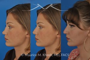 Photo of a patient before and after a procedure. saddle nose rhinoplasty - 27 year old with saddle nose collapse due to an autoimmune condition. She was bothered by the unnatural sag of the bridge of the nose, loss of nasal tip definition, and nasal obstruction. Her own rib cartilage was used during saddle nose rhinoplasty, to reconstruct the nose and restore breathing. The last two images show the computer simulation of surgical outcome (middle picture), as well as the final outcome (the picture on the right side). Patient is delighted with her results. 